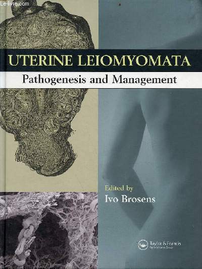 Uterine Leiomyomata Pathogenesis and Management.