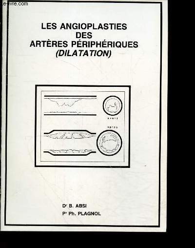 Les angioplasties des arteres peripheriques (dilatation) - principes, mecanismes, indications, contre indications, clinique, bilan, technique...