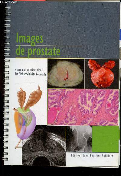 IMAGES DE PROSTATE - prostate normale, hyperplasie a predominance fibreuse / glandulaire - hyperplasie prostatique compliquee- hyperplasie associee a un cancer localise- cancer prostatique evolue