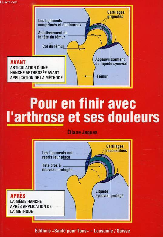 POUR EN FINIR AVEC L'ARTHROSE ET SES DOULEURS